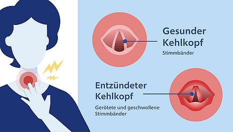 Bei einer Kehlkopfentzündung sind die Stimmbänder gerötet und geschwollen. Infografik Laryngitis